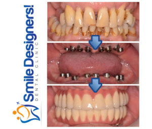 bridge-sur-implants-dentaires-ref3