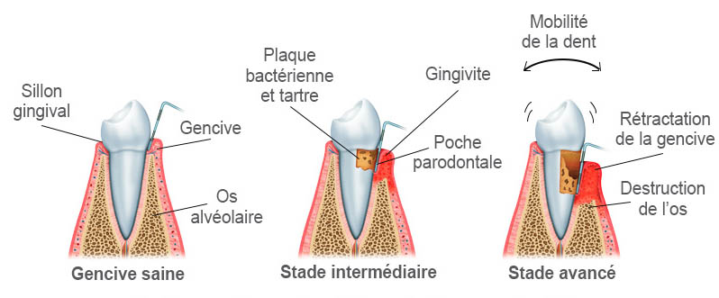Les stades de maladies parodontales