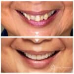 E.Max ceramic crowns