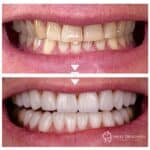 E.Max veneers shade BL3