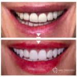 E.Max crowns (shapes realised based on digital smile design)