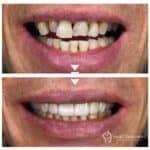 E.Max veneers