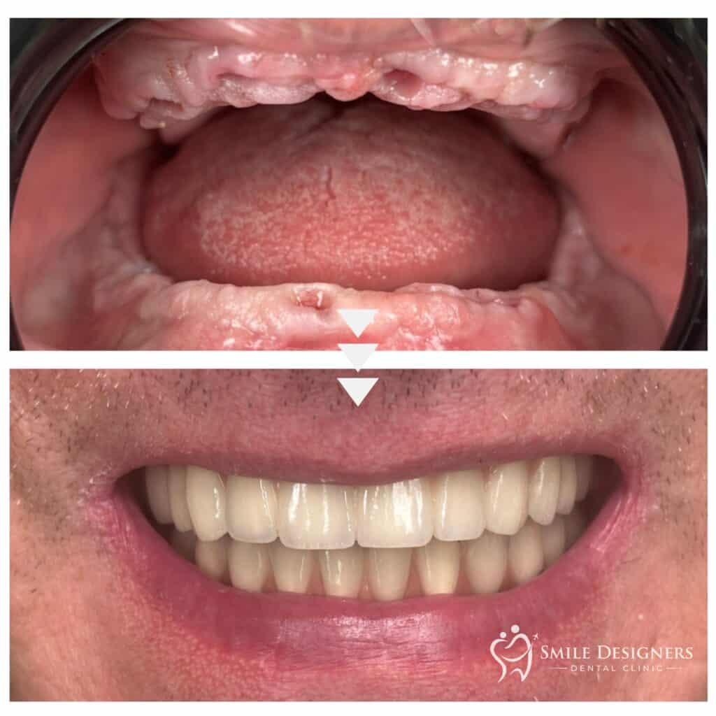 Monolithic zirconia all-on-4 prosthesis
