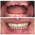 Monolithic zirconia all-on-4 prosthesis