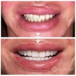 E.Max ceramic crowns