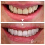 Gum recontouring and zirconia crowns