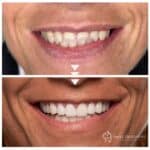 E.Max ceramic veneers with bite correction