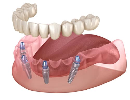 Fixed bridge on 4 implants