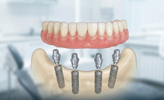 Immediate fixed denture All-on-4