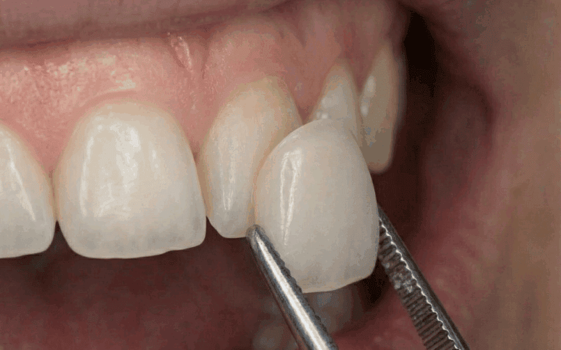 dental-veneers
