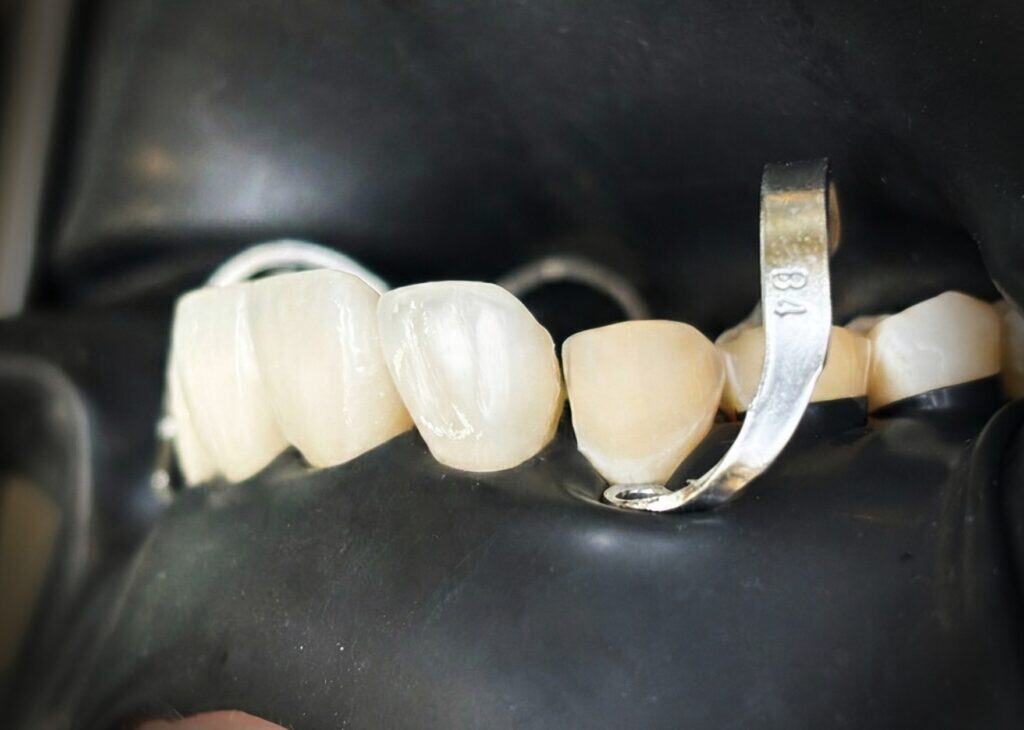 Ceramic veneers vs composite bonding