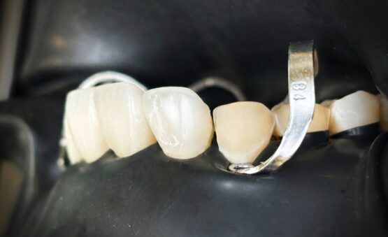 Ceramic veneers vs composite bonding