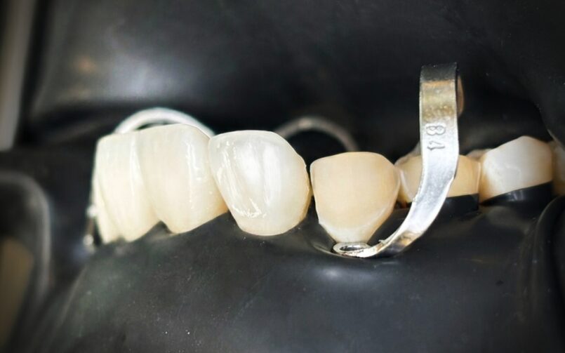 Ceramic veneers vs composite bonding