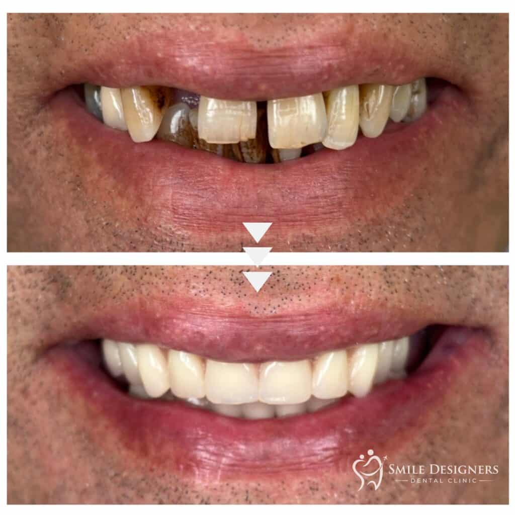 temporary-prosthesis-all-on-4