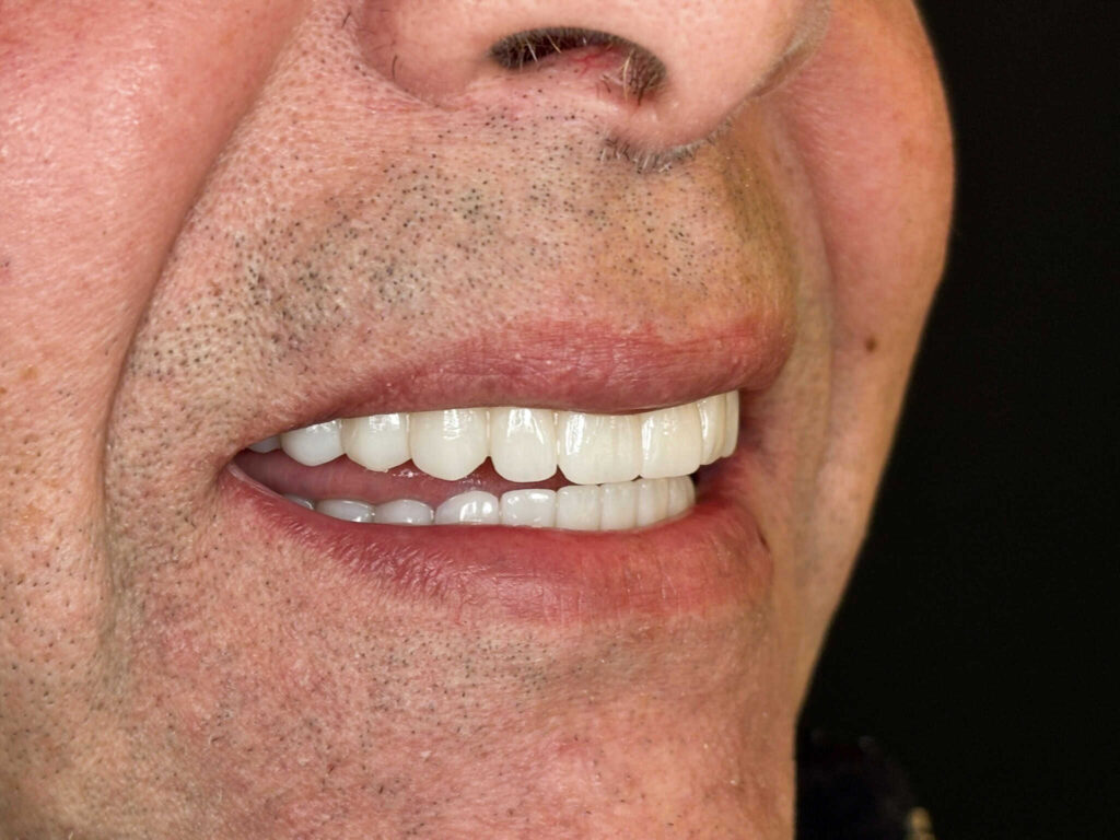 All-on-4 zirconium prosthesis