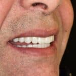 All-on-4 zirconium prosthesis