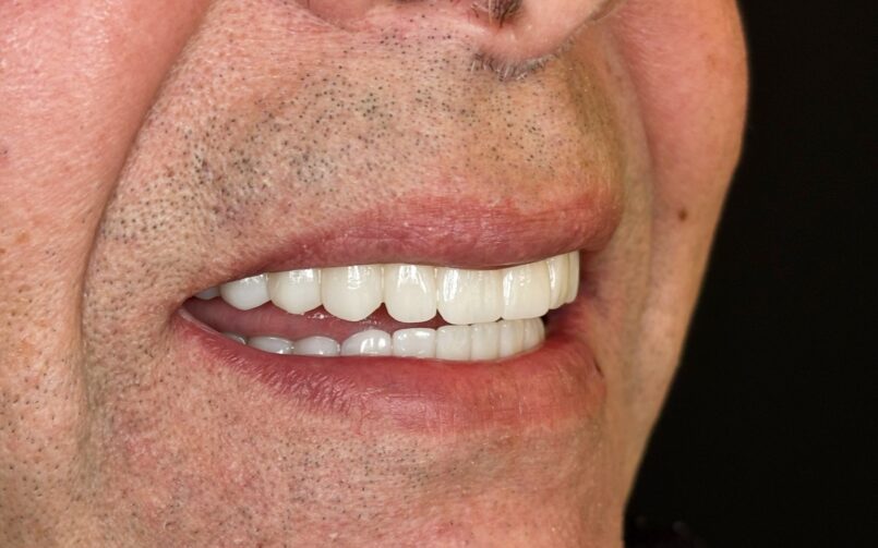 All-on-4 zirconium prosthesis