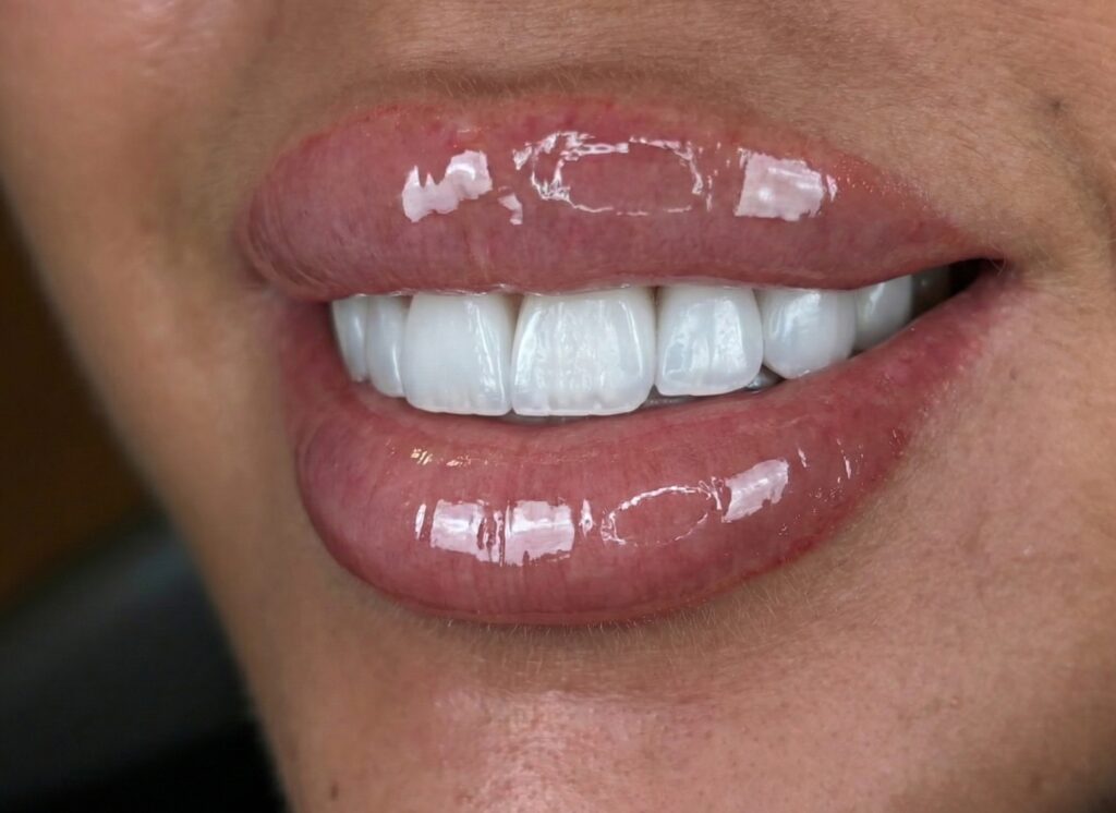 Emax veneers - A case study