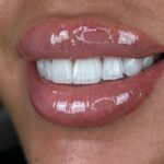Emax veneers - A case study
