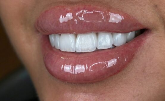 Emax veneers - A case study