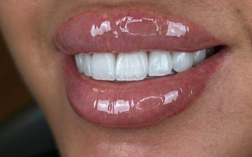 Emax veneers - A case study