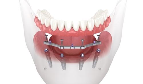 Dental Replacements: From Dentures to All-on-4